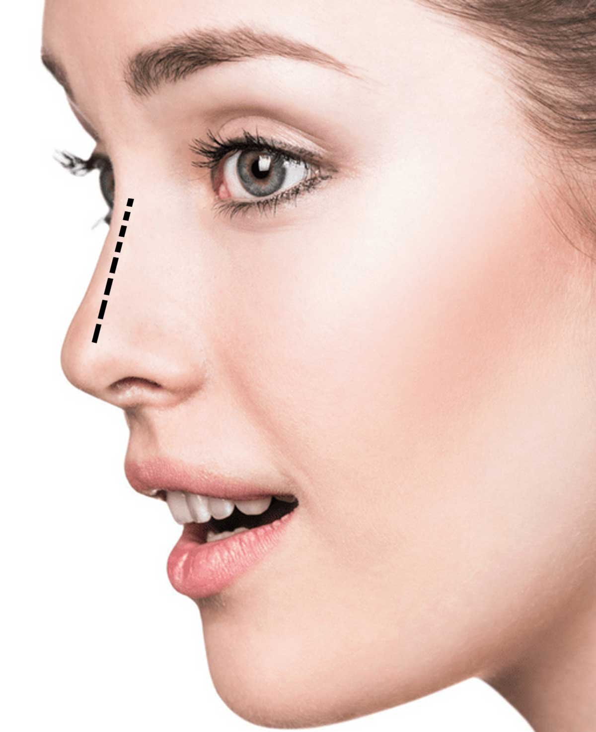 Rhinoplasty